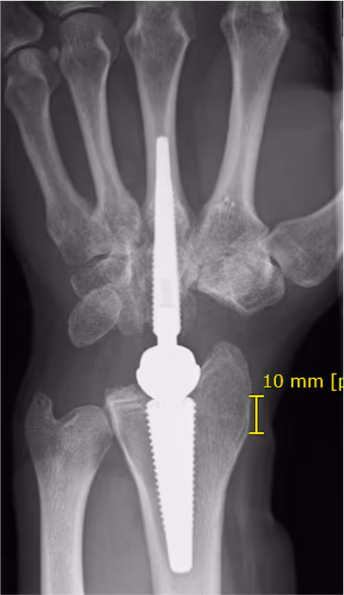 Arthrose des Handgelenks